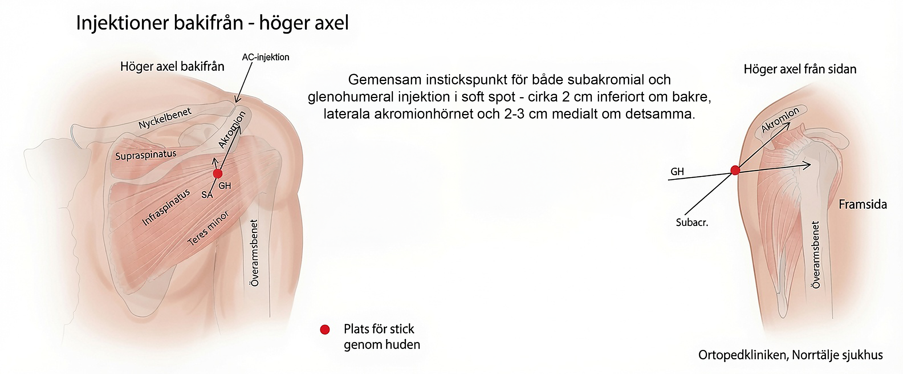 Injektioner bakifrån — höger axel med anatomiska landmärken och instickställen